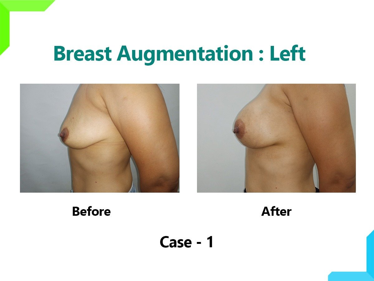 Breast Augmentation Breast Augmentation