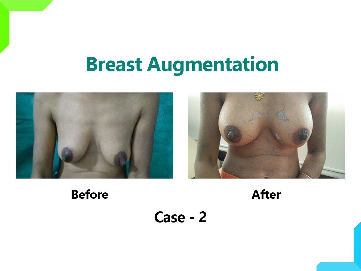 Breast Augmentation Breast Augmentation