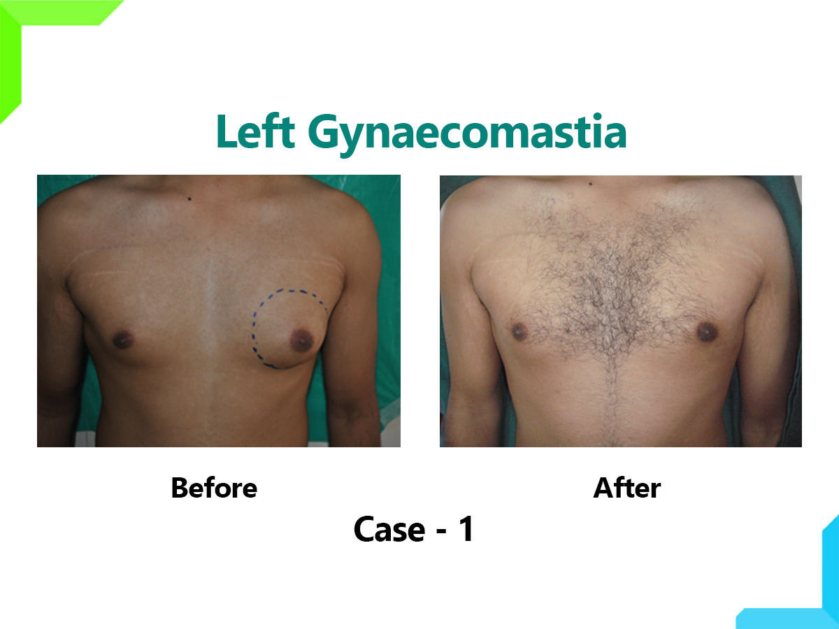 Left Gynaecomastia Left Gynaecomastia