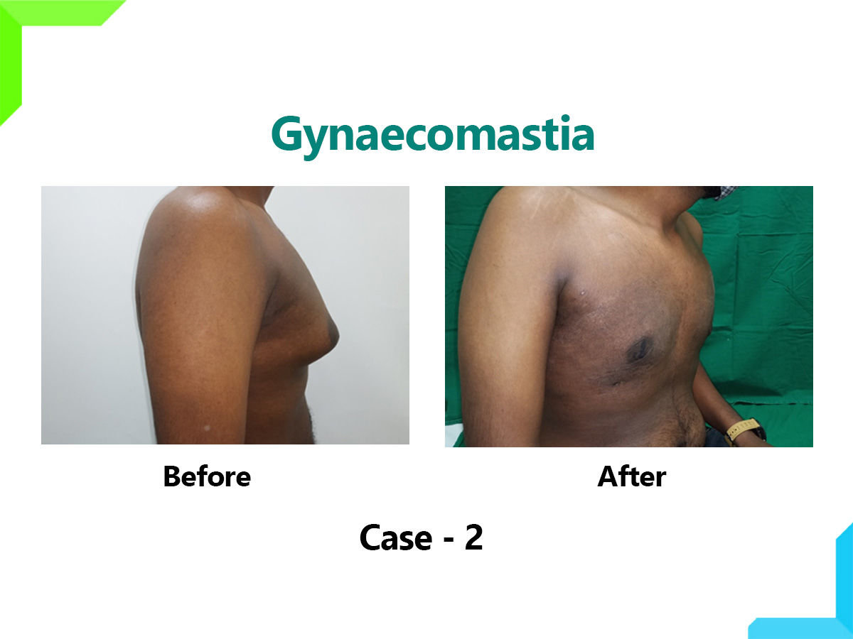 Gynaecomastia Gynaecomastia