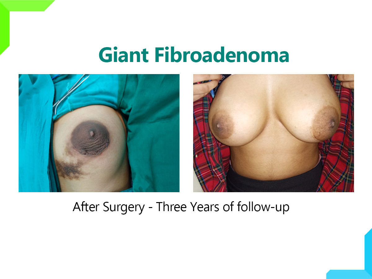 Giant Fibroadenoma Giant Fibroadenoma
