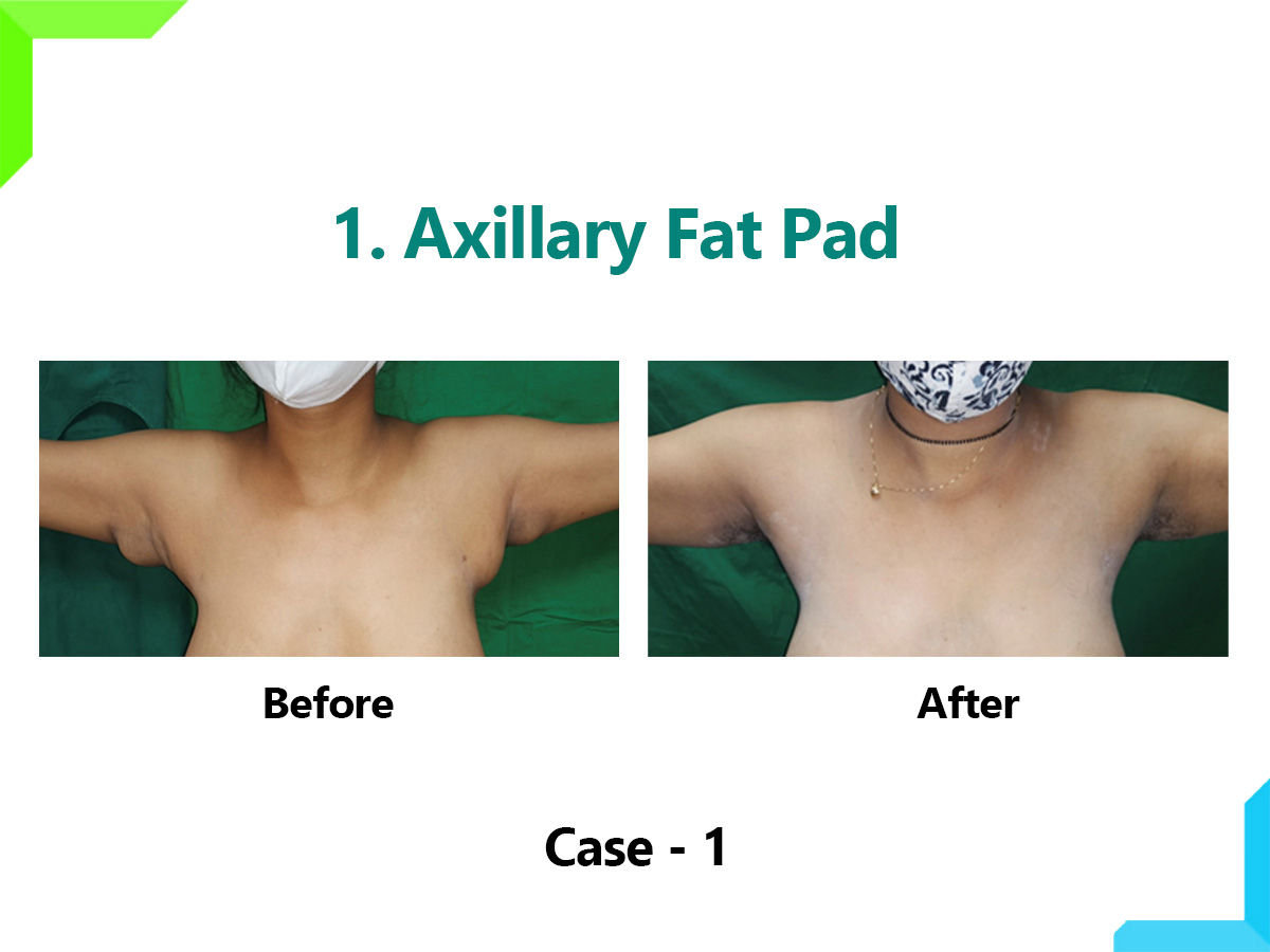 Axillary Fat Pad Axillary Fat Pad