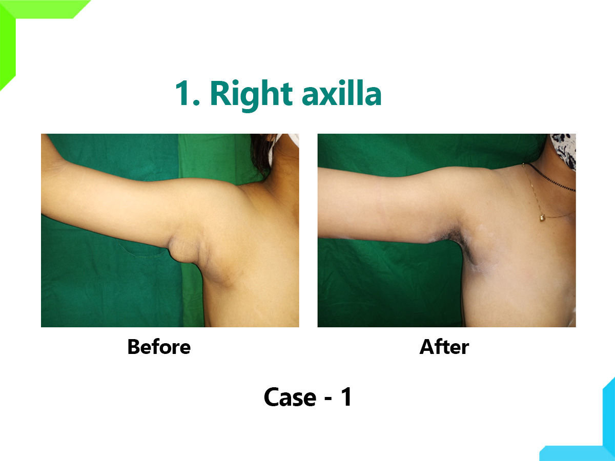 Right axilla Right axilla