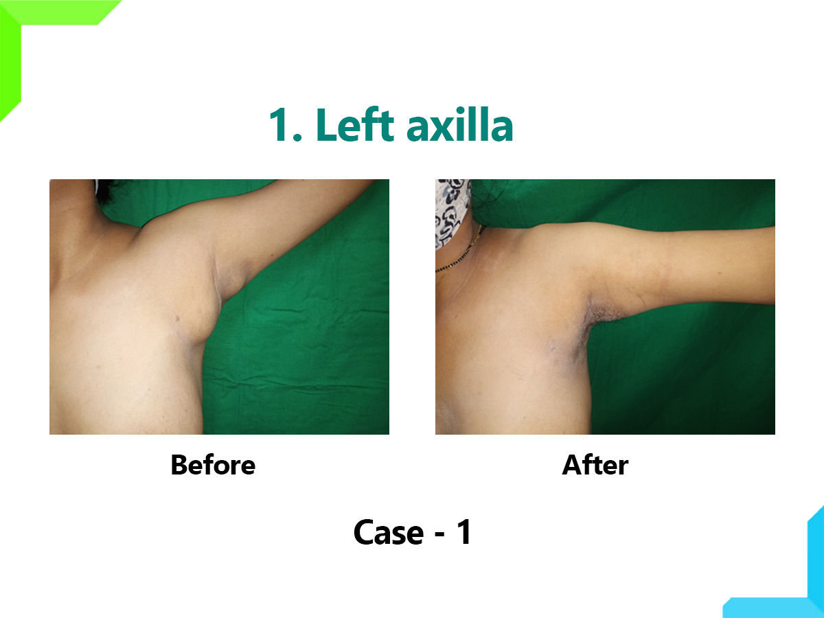 Left axilla Left axilla