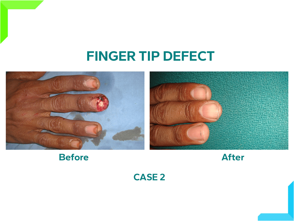 Finger Tip Defect Finger Tip Defect