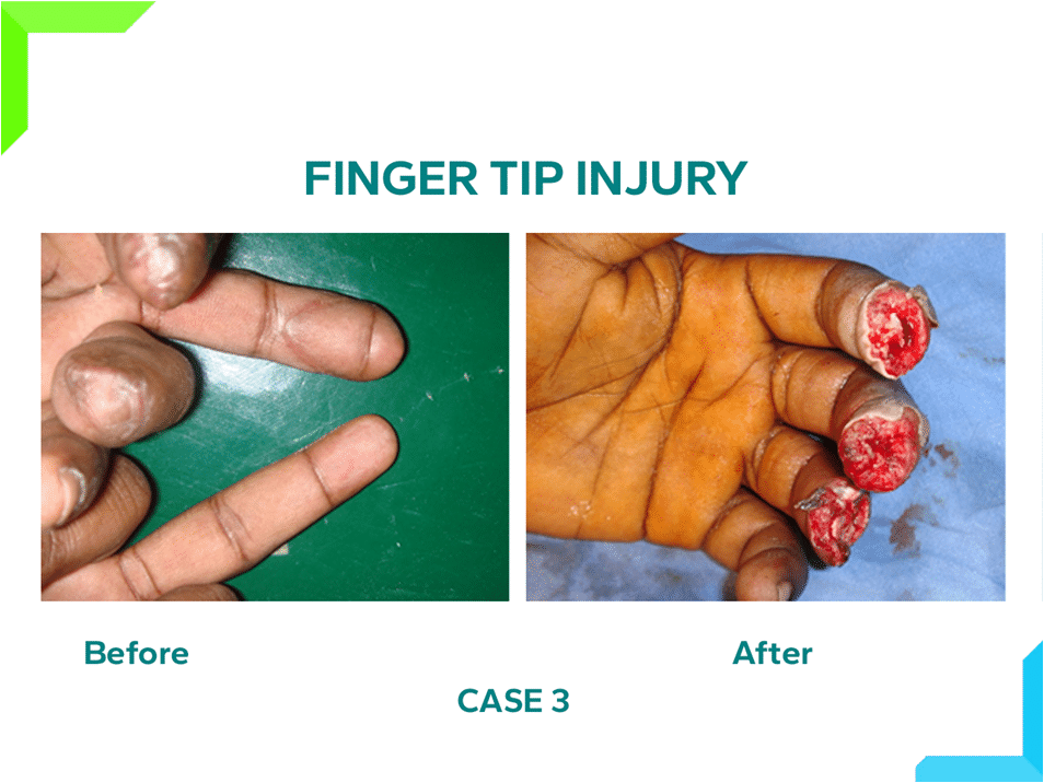 Finger Tip Injury Finger Tip Injury