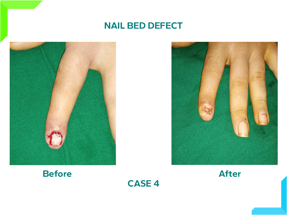 Nail Bed Defect Nail Bed Defect