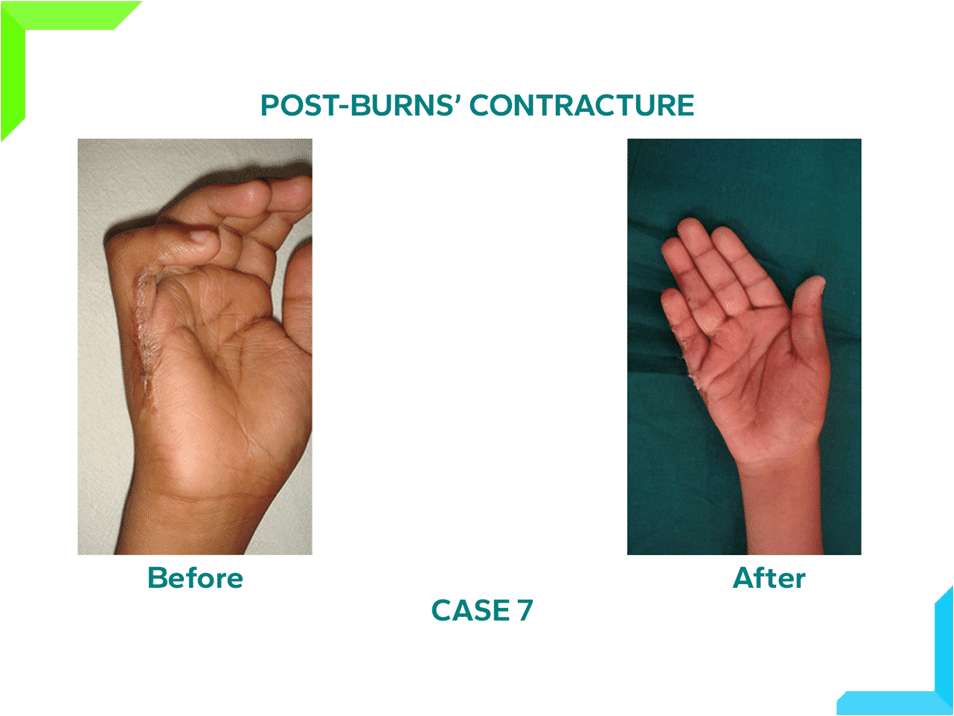 Post Burns Contracture Post Burns Contracture