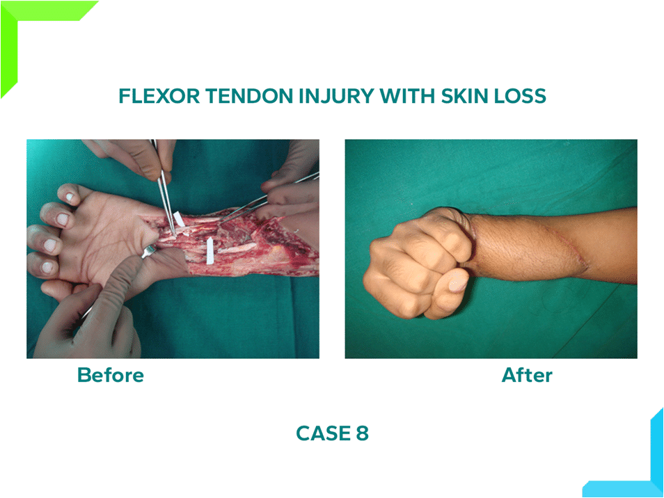 Flexor Tendon Injury