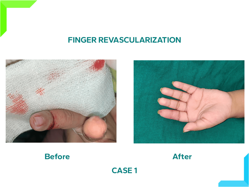 Finger Revascularization Finger Revascularization