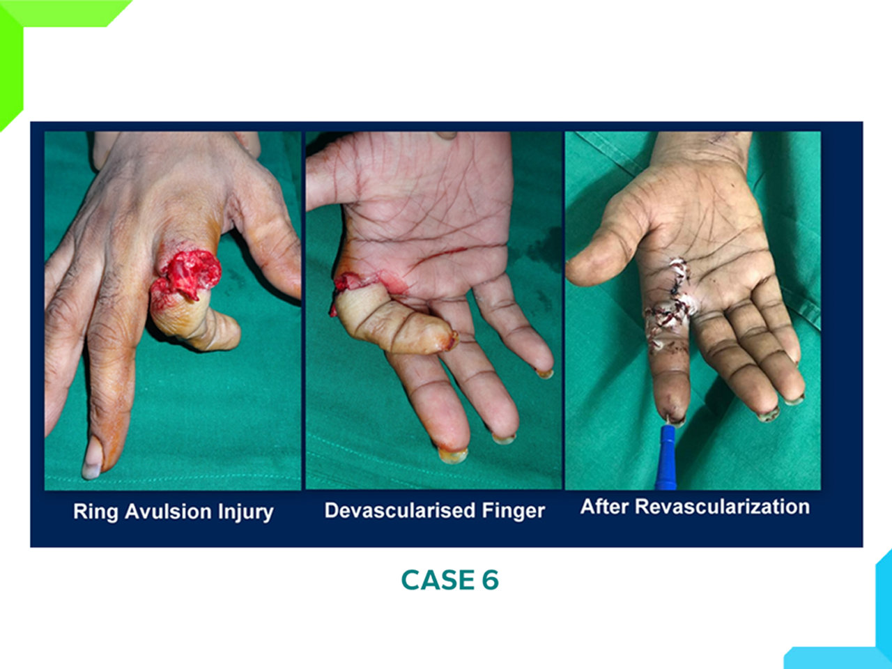 Finger injury Finger injury