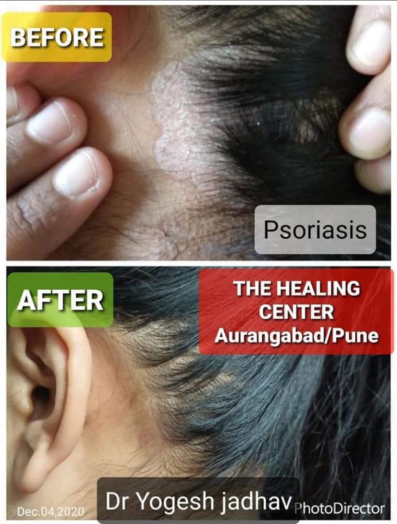Psoriasis Psoriasis