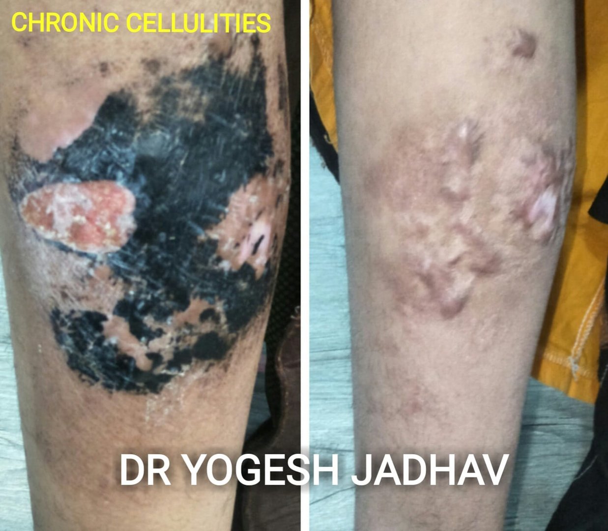 Chronic Cellulities Chronic Cellulities