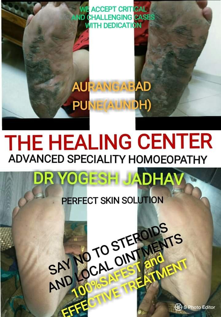 skin infection skin infection