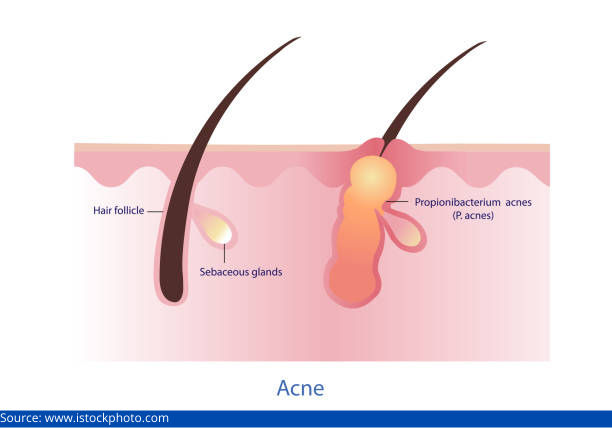 Acne-prone skin