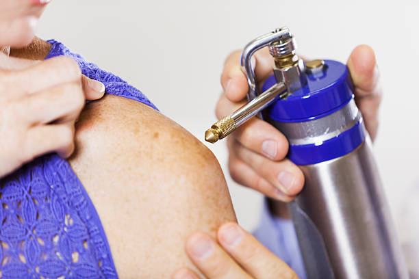 Best Cryosurgery Los Angeles & Santa Monica | Dr. Tanya Kormeili Dermatology