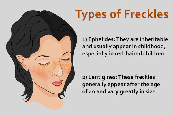 Freckles: Types, Causes, and Treatment - eMediHealth