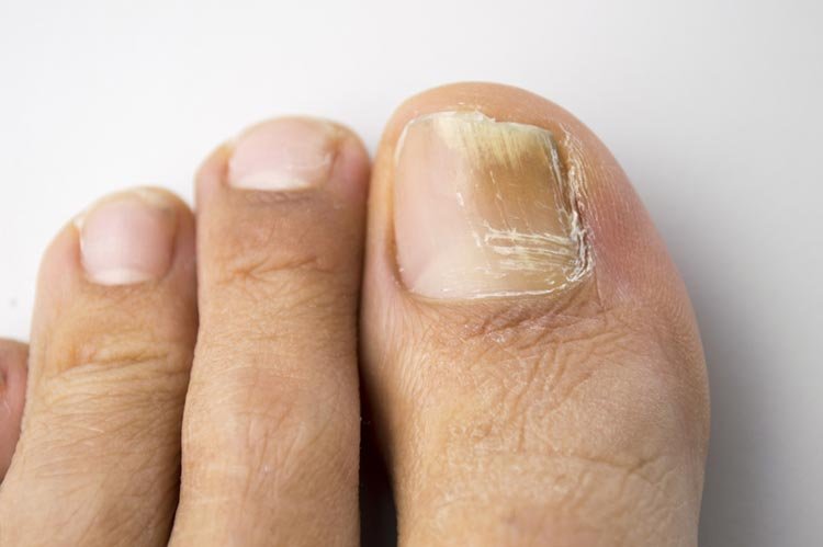 Fungal nail problems - MyDr.com.au