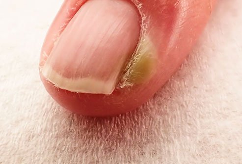 Nail Bed Injuries Treatment | Sydney Orthopaedic Surgeon