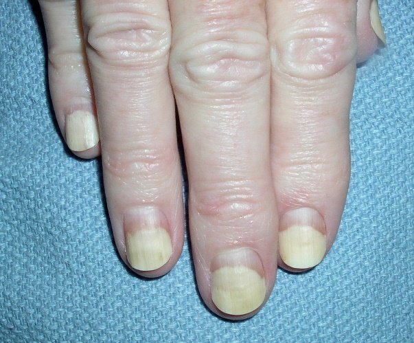 What you need to know about pseudomonas nail infections aka 