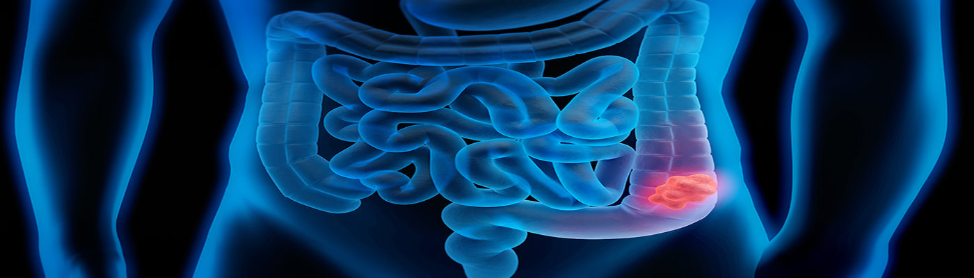 colon cancer colon cancer