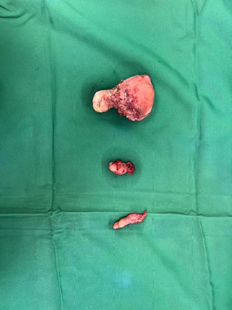 Abdominal hystrectomy Abdominal hystrectomy
