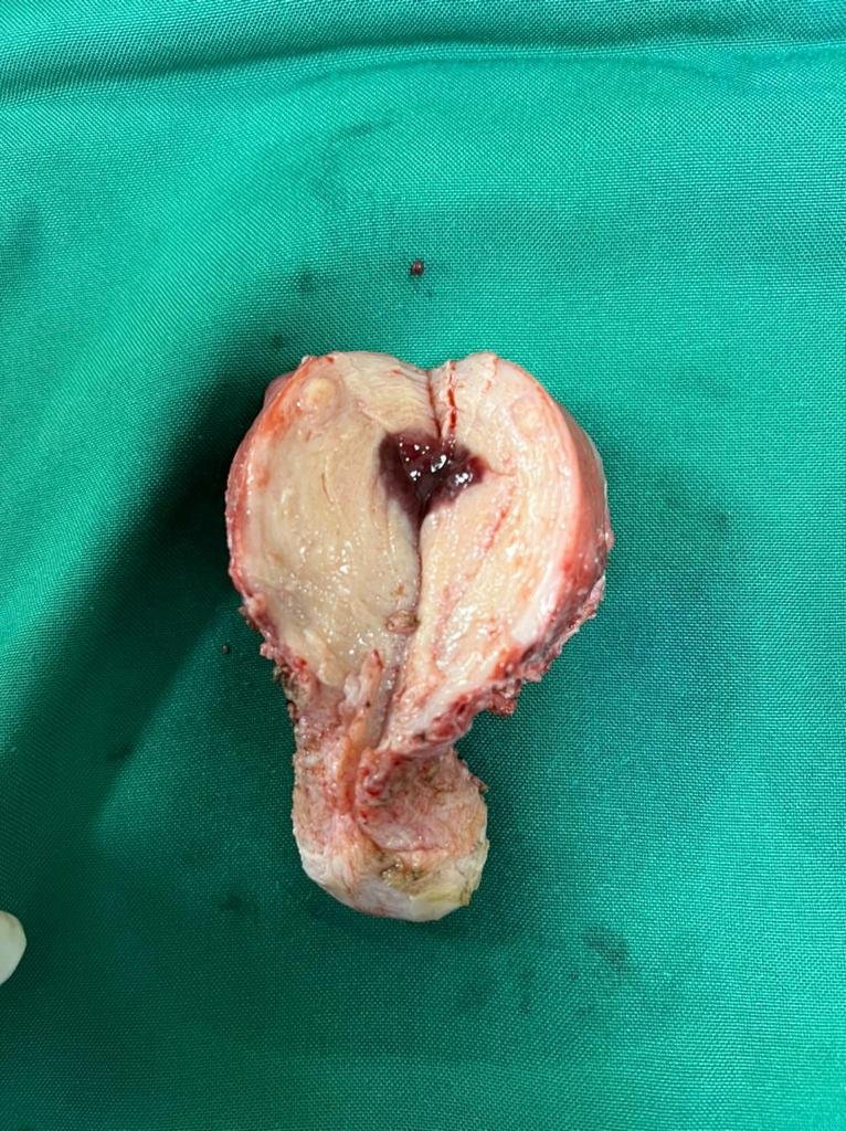 Abdominal hystrectomy Abdominal hystrectomy