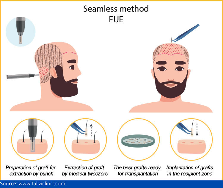 Is it Better for a Hair Transplant Doctor or Technician to do Your Surgery