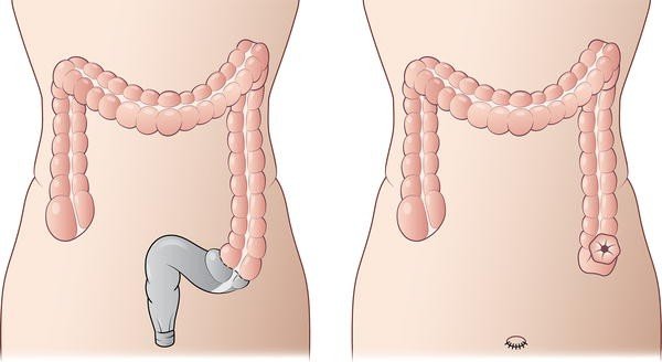 Figure 13 | Post-operative colon and urinary diversions: surgical  techniques, anatomy, and imaging findings | SpringerLink