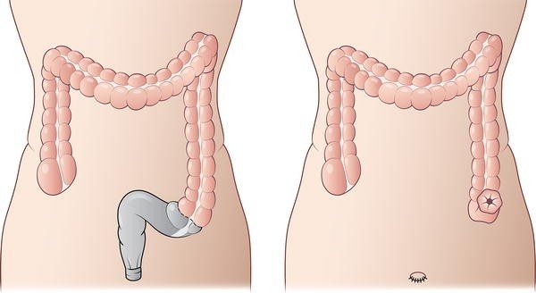 Figure 13 | Post-operative colon and urinary diversions: surgical techniques, anatomy, and imaging findings | SpringerLink