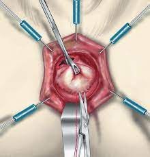 Intersphincteric Resection Pushing the Envelope for Sphincter Preservation. - Abstract - Europe PMC