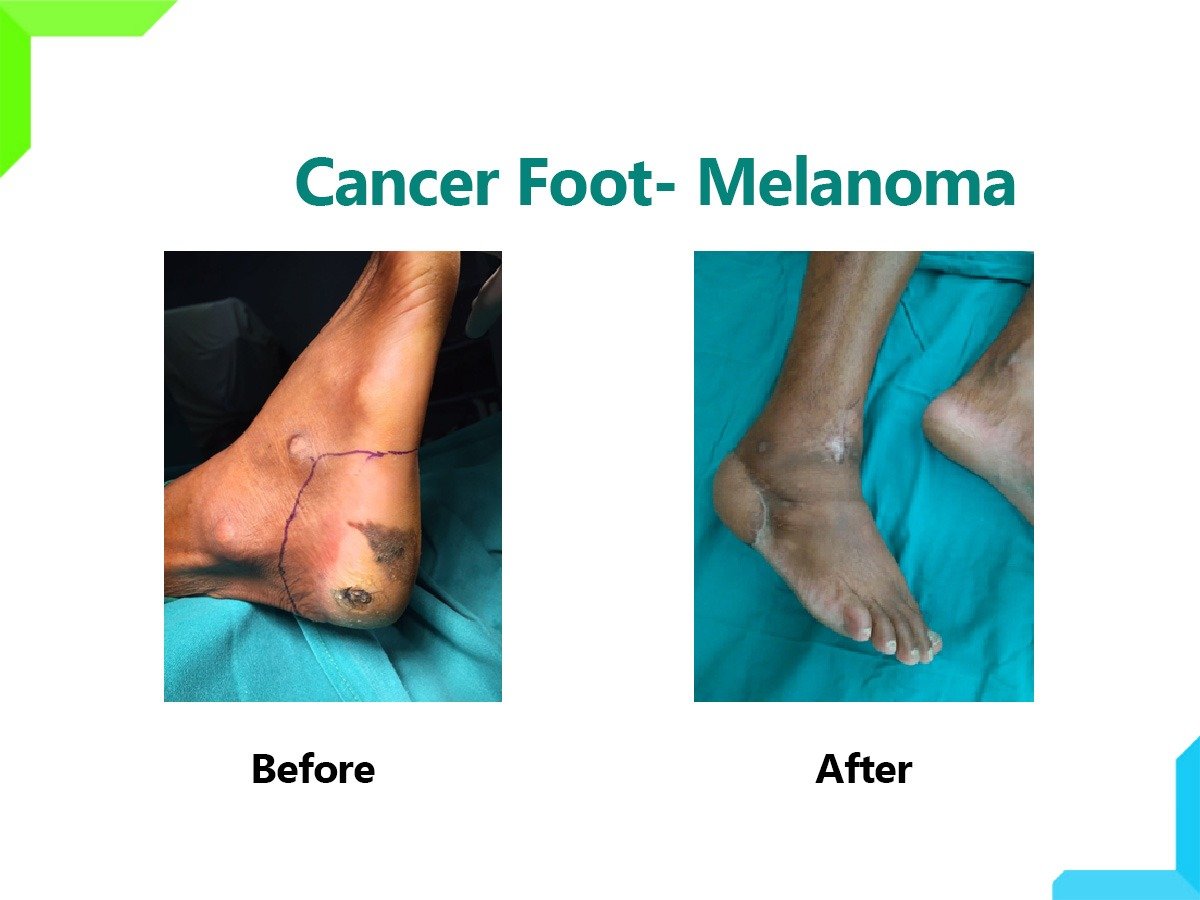 Cancer foot Cancer foot