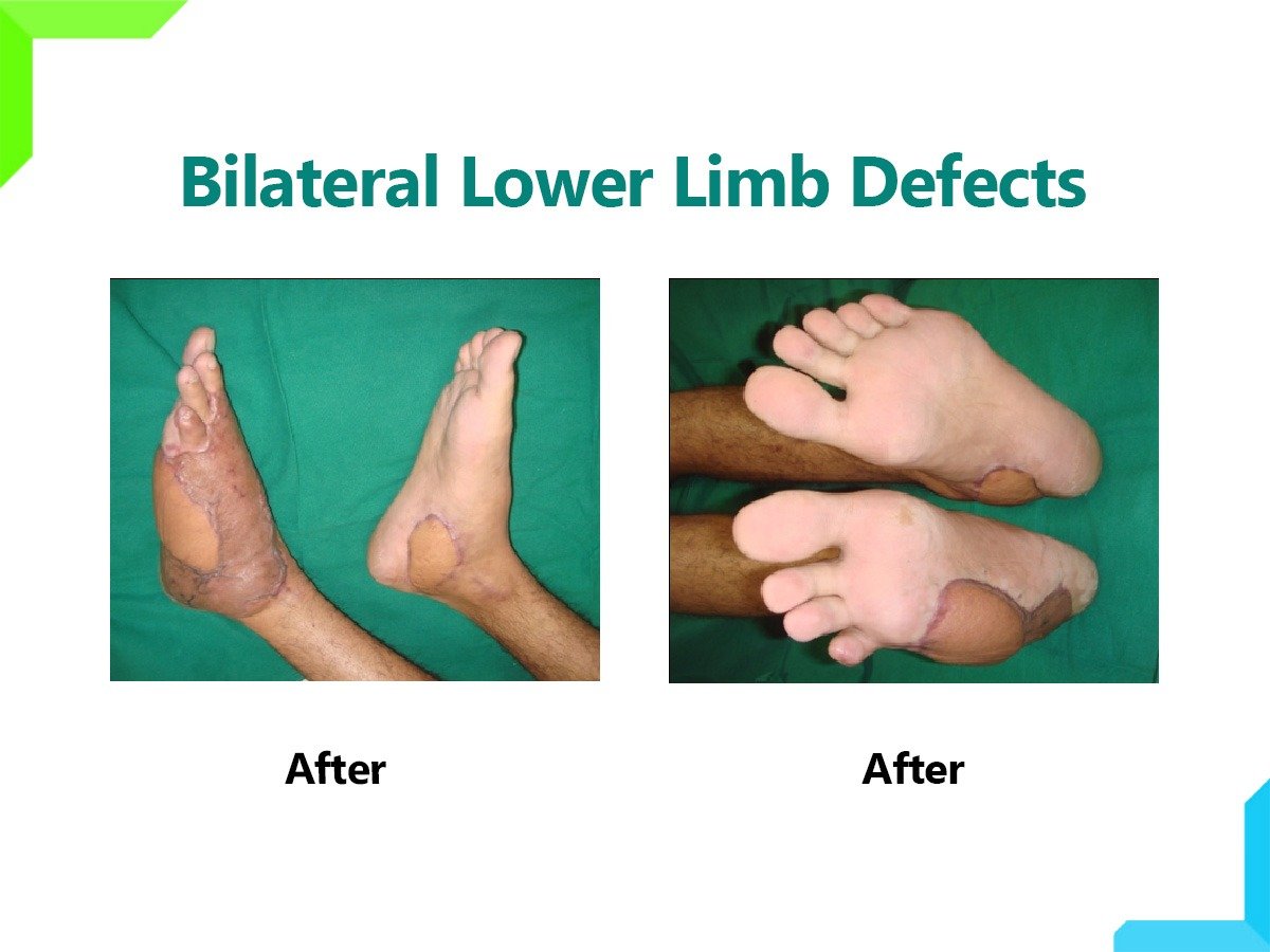 limb limb