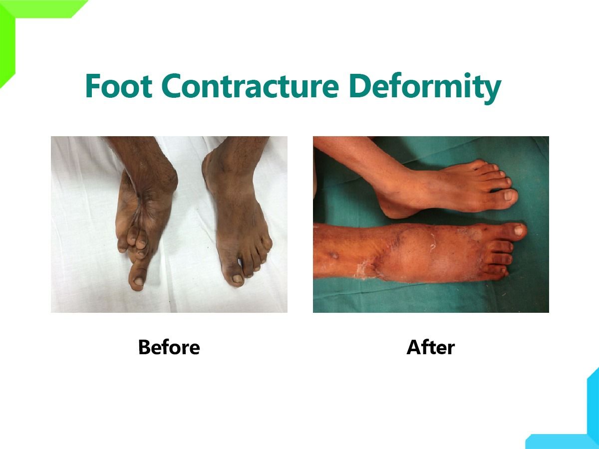 Foot Contracture