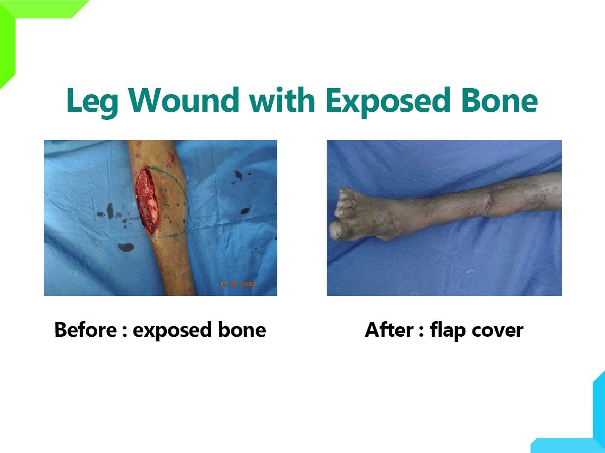 Exposed Bone Exposed Bone