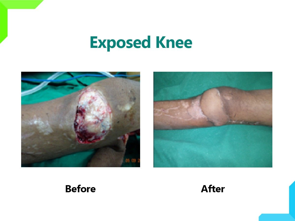 Exposed Knee Exposed Knee