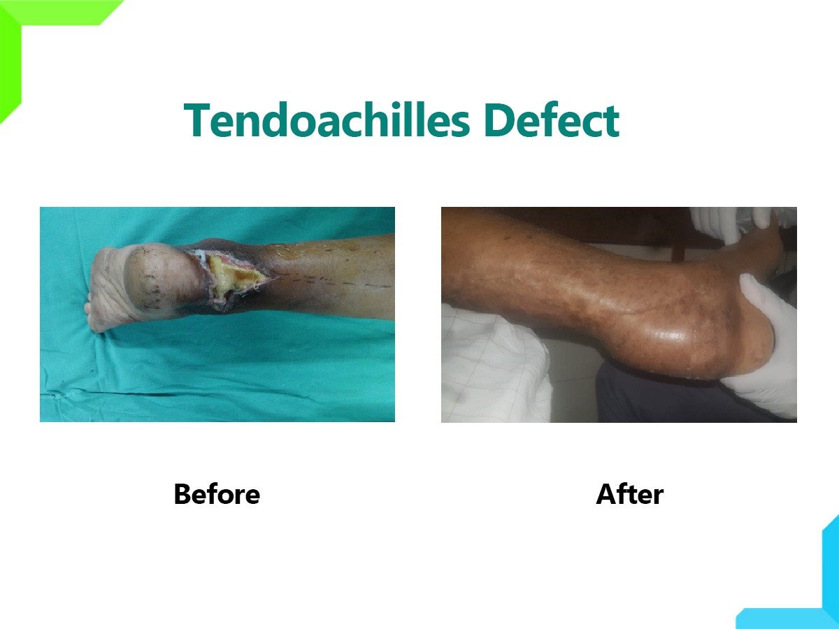 Tendoachilles Tendoachilles