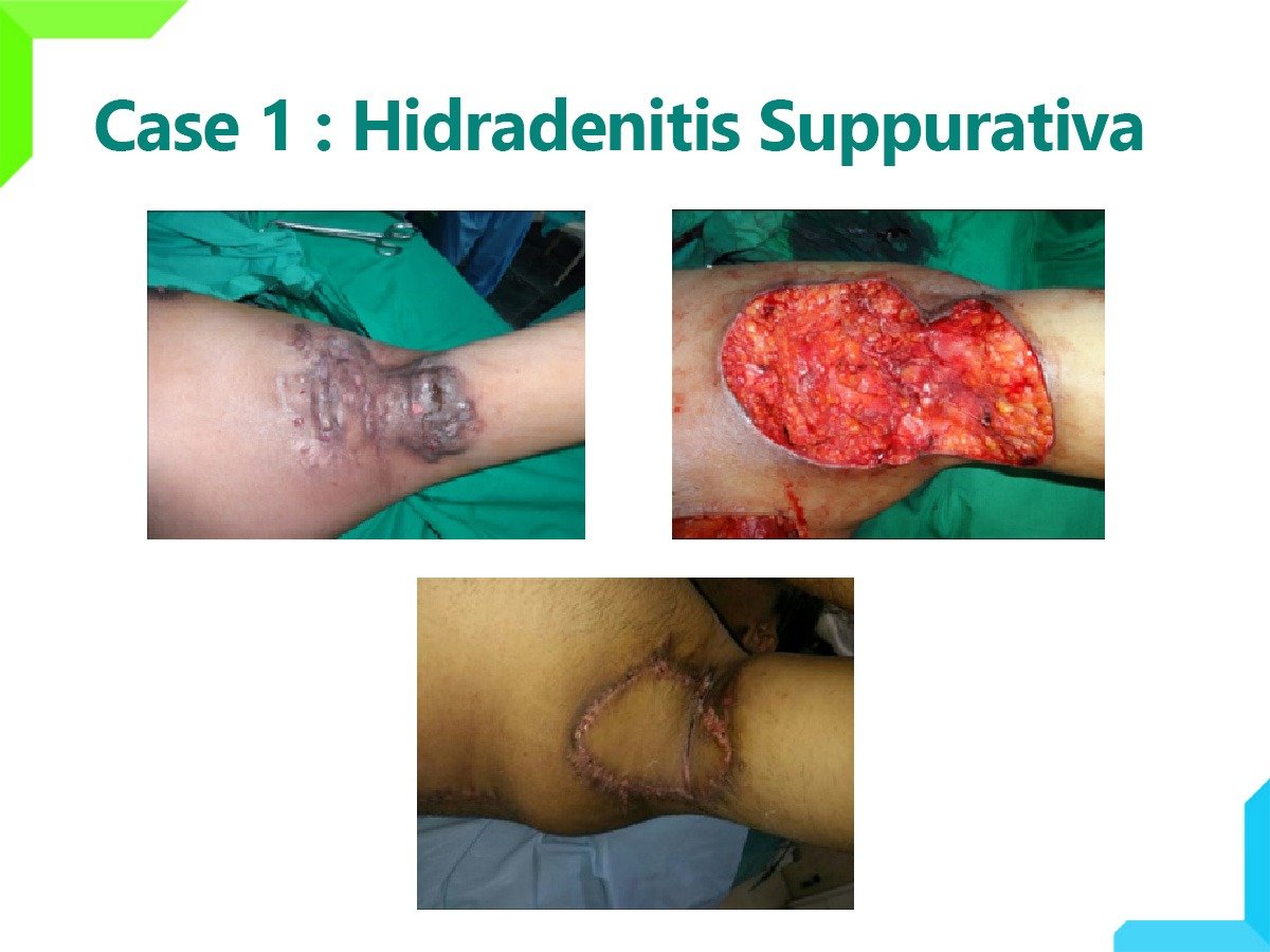 Hidradenitis Suppurativa Hidradenitis Suppurativa