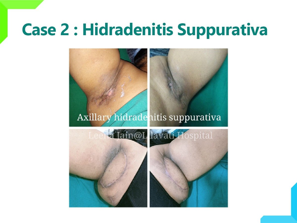 Hidradenitis Suppurativa Hidradenitis Suppurativa