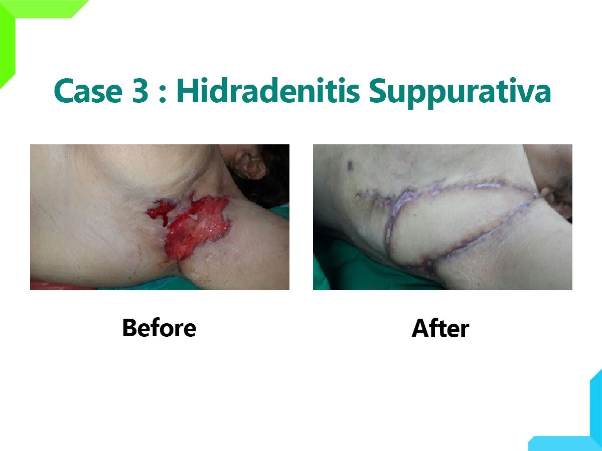 Hidradenitis Suppurativa Hidradenitis Suppurativa
