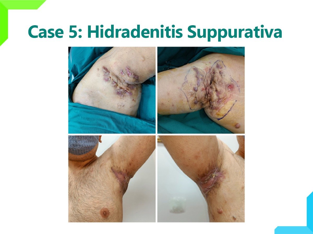 Hidradenitis Suppurativa Hidradenitis Suppurativa