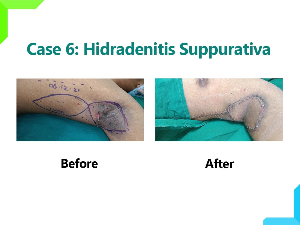 Hidradenitis Suppurativa Hidradenitis Suppurativa