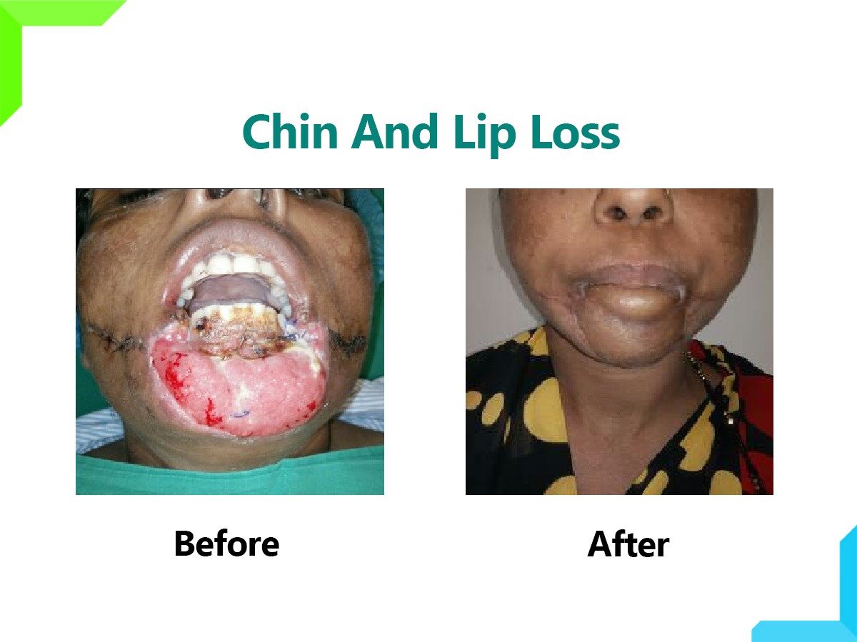 CHIN AND LIP LOSS CHIN AND LIP LOSS