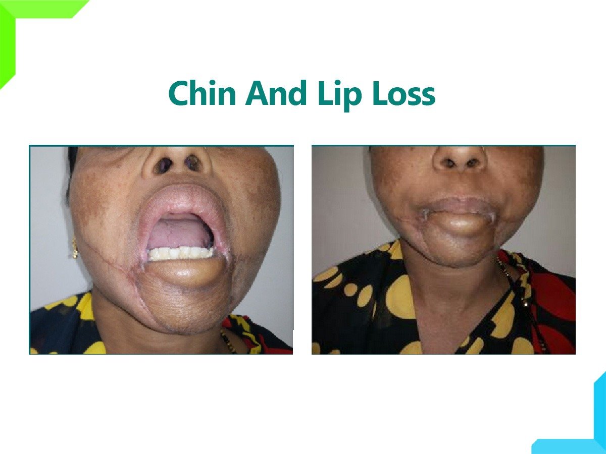 CHIN AND LIP LOSS CHIN AND LIP LOSS