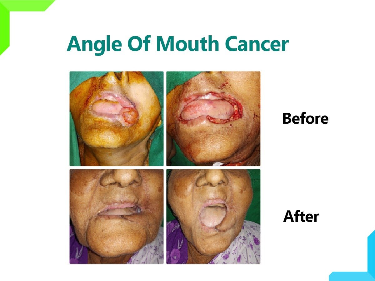 mouth cancer mouth cancer