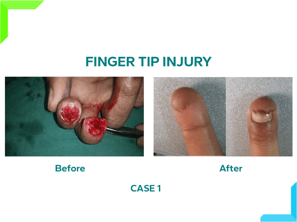 Finger Tip Injury Finger Tip Injury