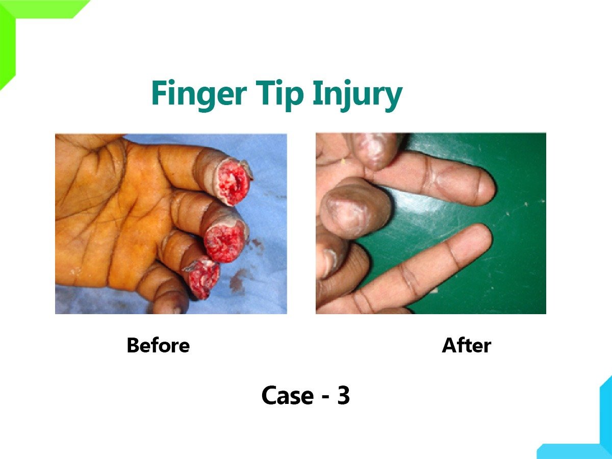 Finger Tip Injury Finger Tip Injury