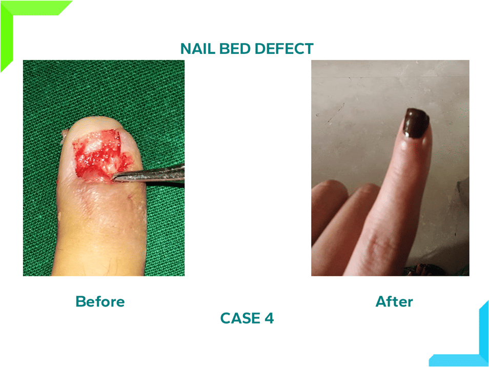 Nail Bed Defect Nail Bed Defect