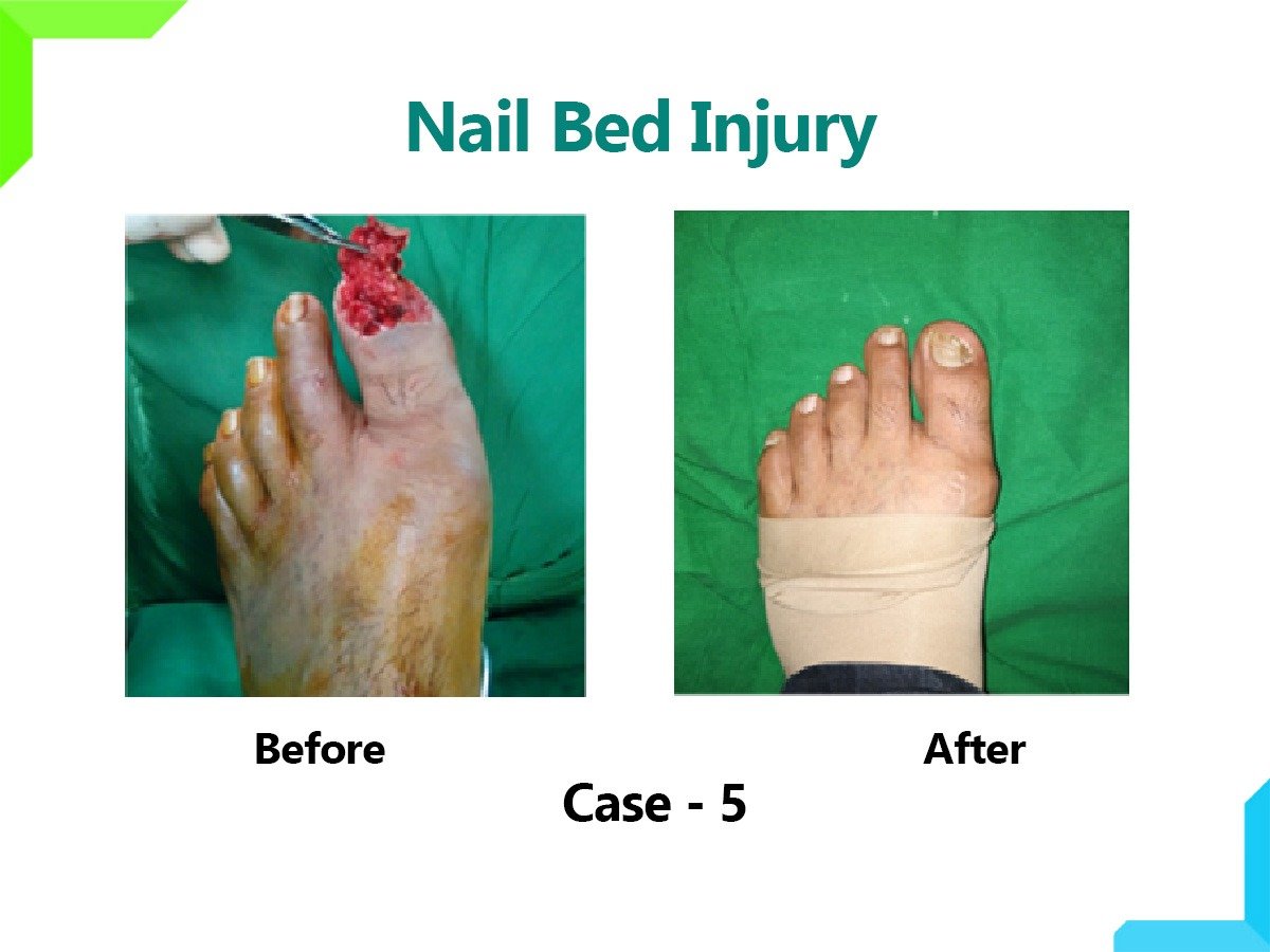 Nail Bed Injury Nail Bed Injury