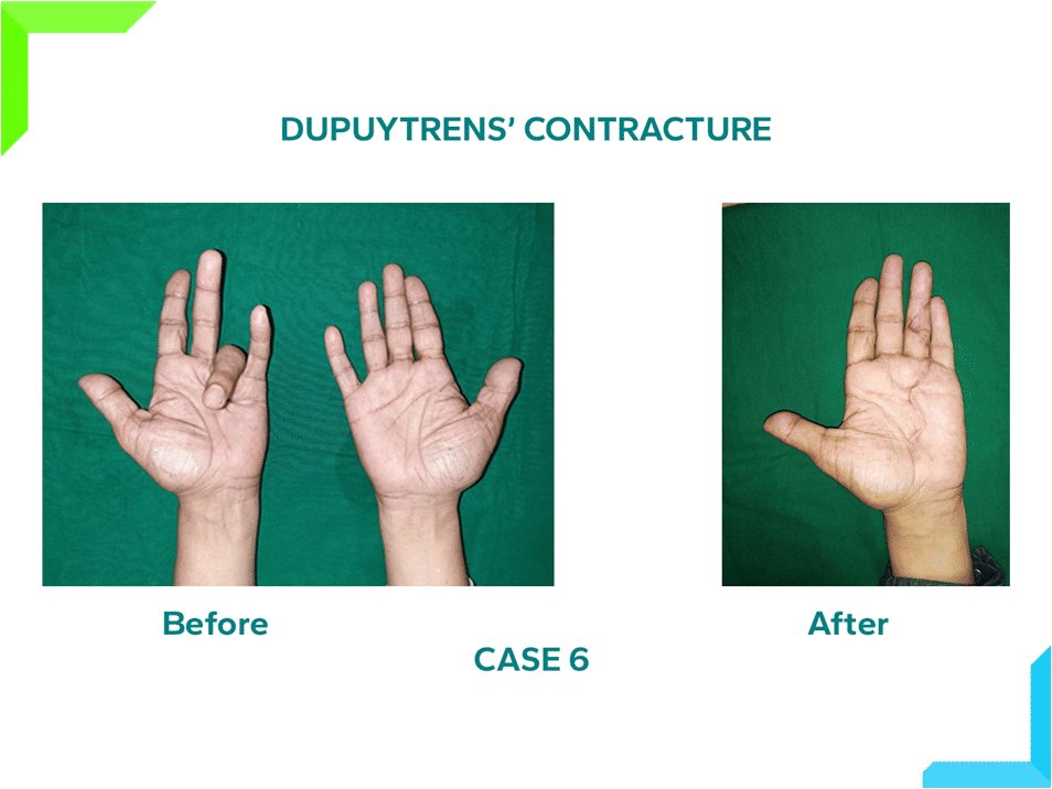 Dupuytren's Contracture Dupuytren's Contracture